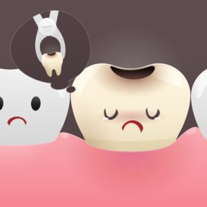 Retirando un diente con caries