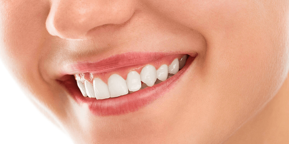 Blanqueamiento dental profesional de Clinica Sorias