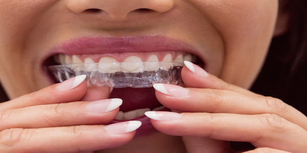 Chica colocándose la funda dental invisalign
