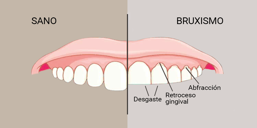 Protectores nocturnos para proteger los dientes y las encías Representacion Bruxism