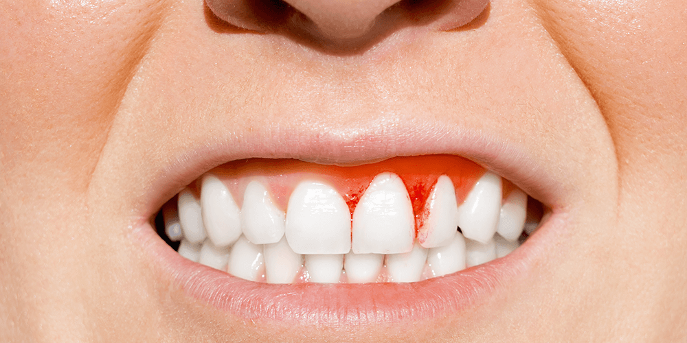 Mujer con las encías sangrando al despertar