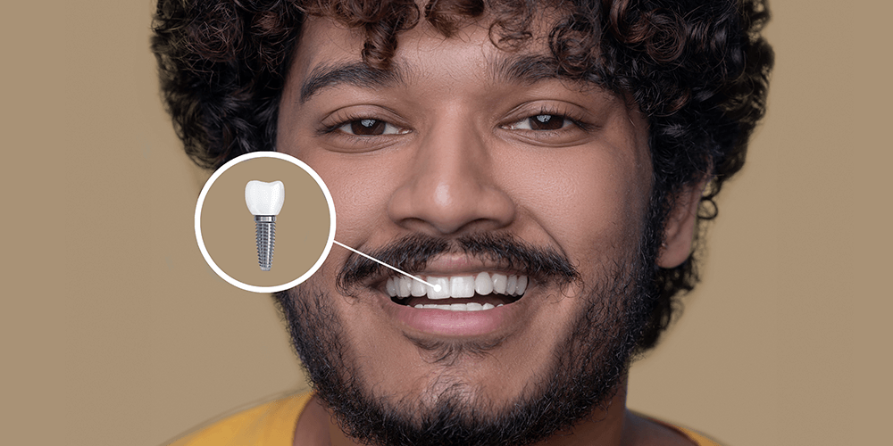 Hombre de mediana edad y pelo rizado con una Postoperatorio de implantes dentales