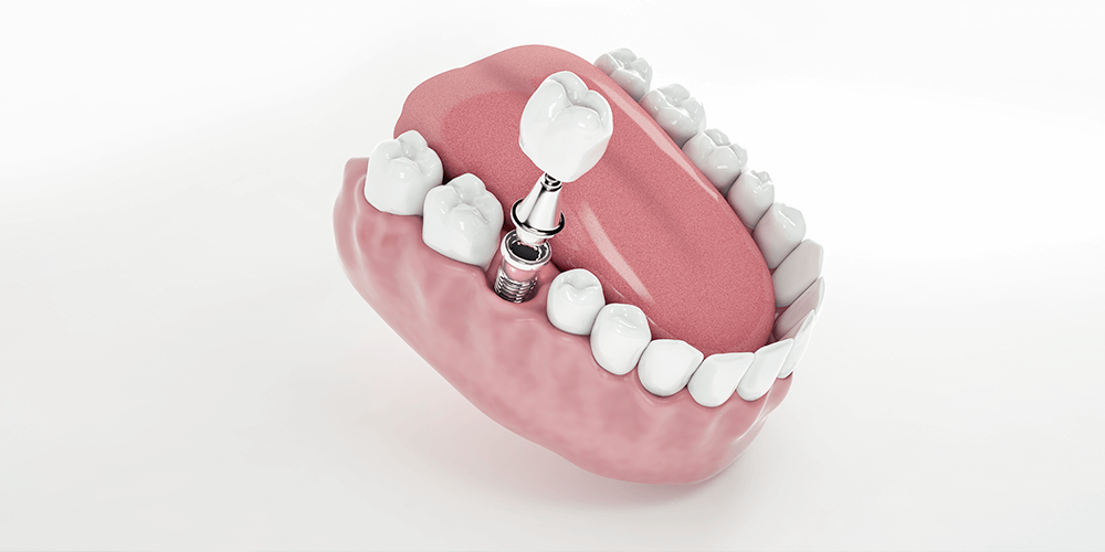 De qué están hechos los implantes-- Clinica Soria en Salamanca