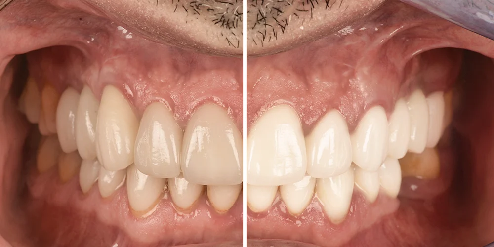 Dientes antes y despues de una limpieza y un tratamiento para manchas - Clínica dental Soria - Salamanca