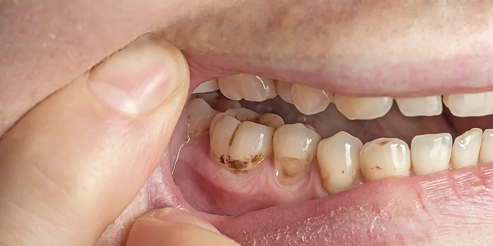 Mancas Marrones en los dientes - Clínica Dental Soria - Salamanca