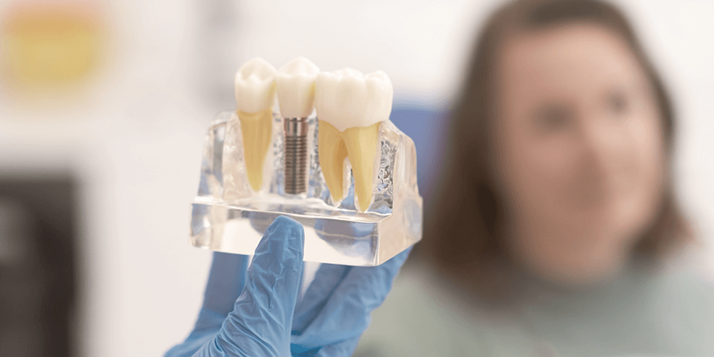 Qué es un implante y cómo funciona -- Clinica Soria en Salamanca