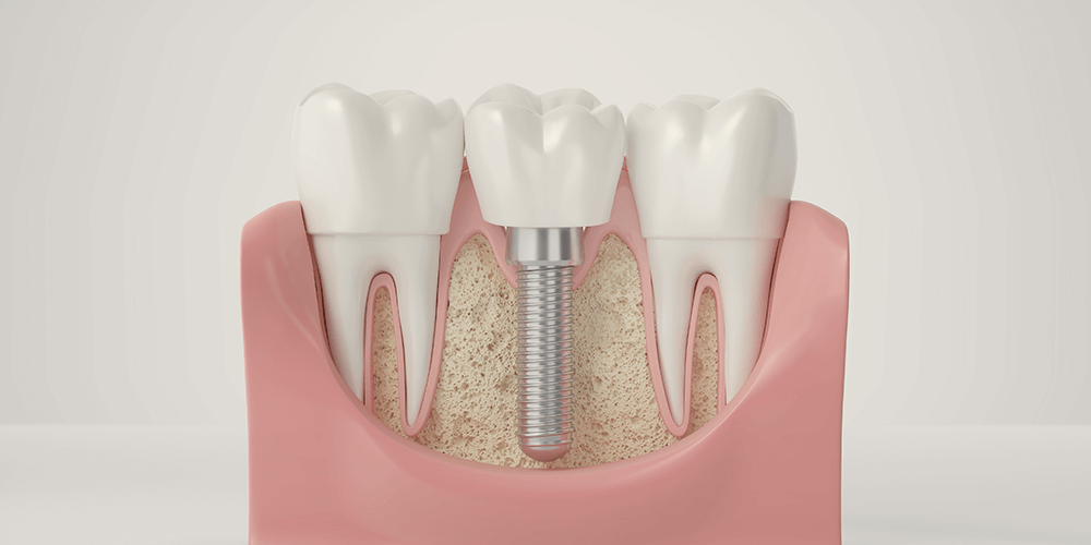 Tipos de implantes y reconstrucción de dientes - Clinica Soria en Salamanca