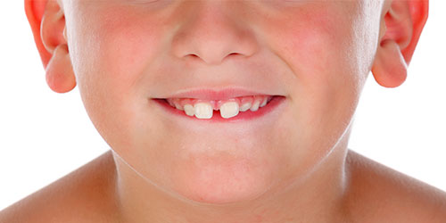 Niño con diastema