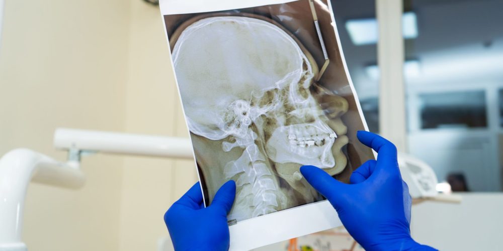 Radiografía de unos implantes dentales