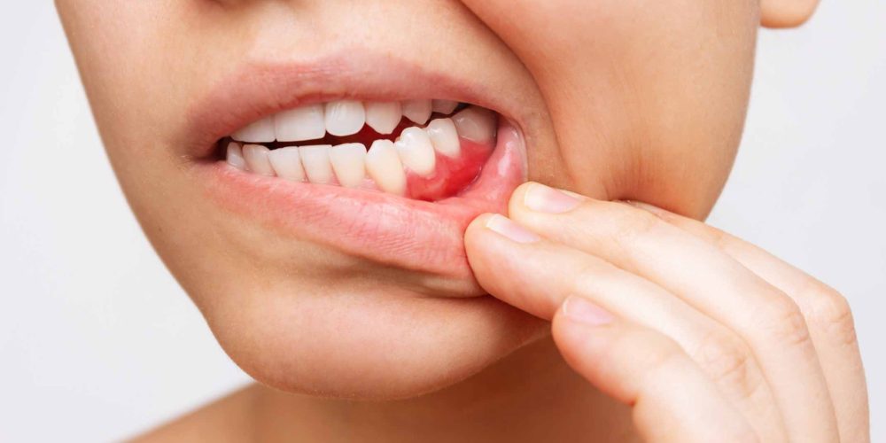Inflamación de las encías por periodontitis o piorrea