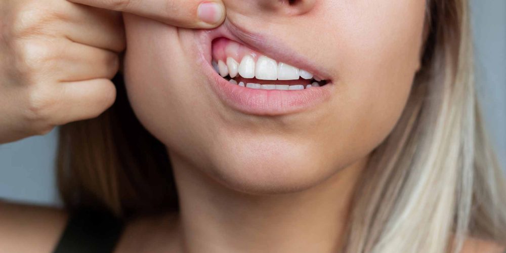 Mujer con problemas en las encias