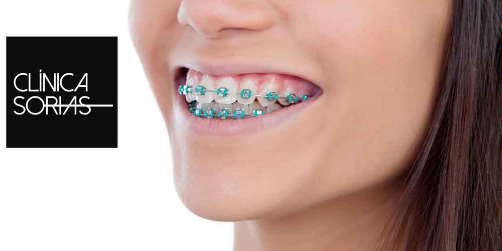 Chica enseñando sus dientes con ortodoncia metálica