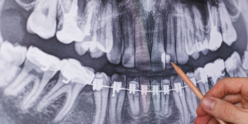 Radiografía caries