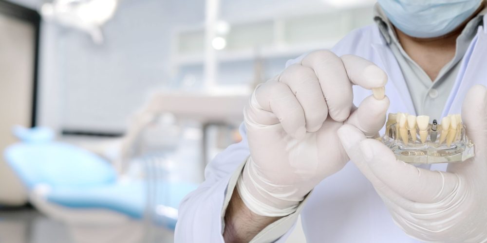 Dentista preparando un molde con implantes dentales